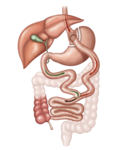 Gastric Bypass