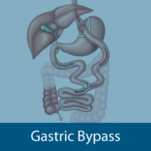 Gastric Bypass