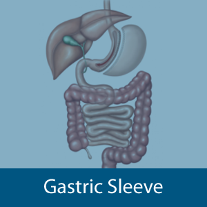 Gastric Sleeve